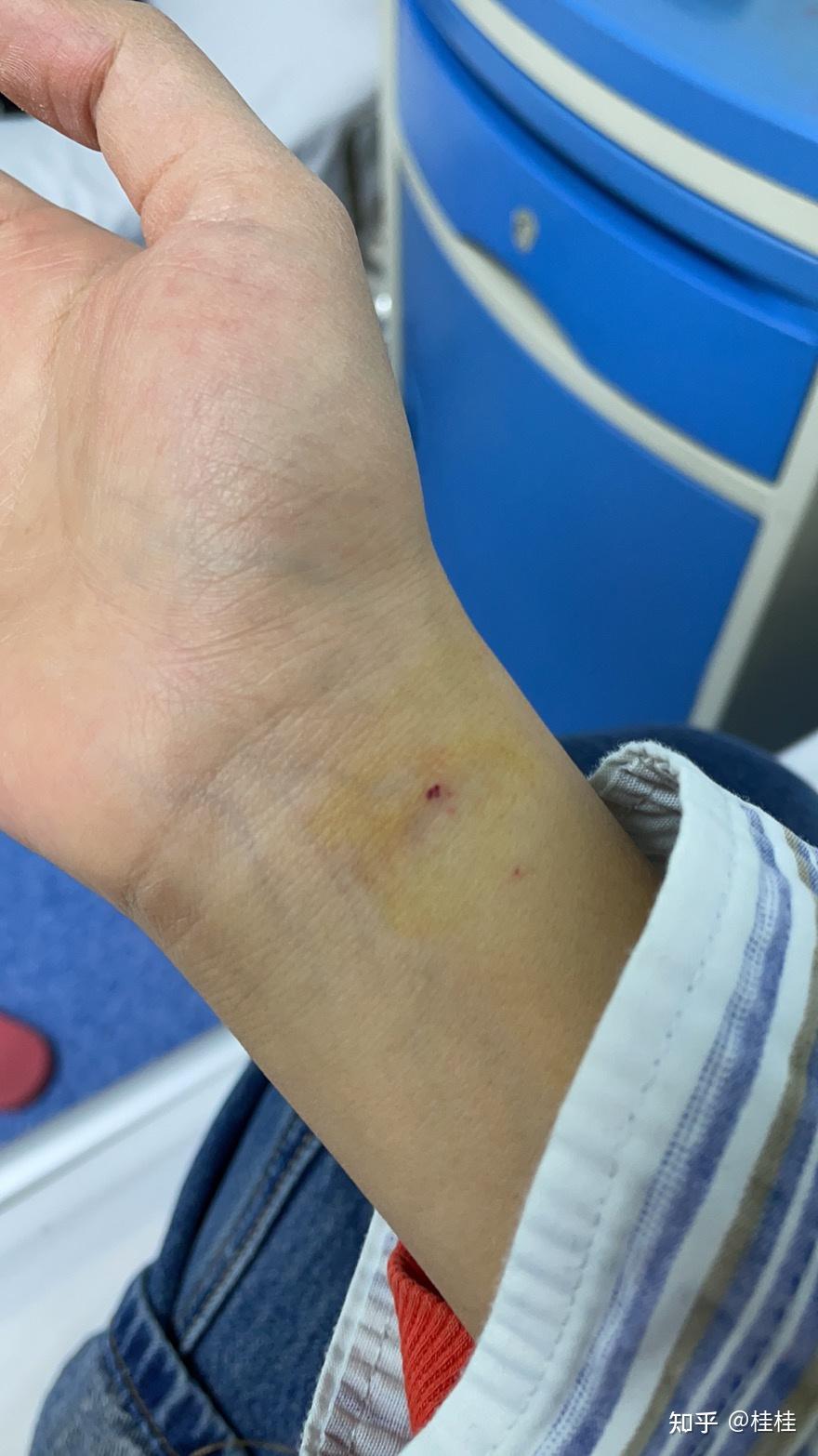 在一点半的时候抽完了血,手肘各一针,手腕各一针,抽大动脉的血可真疼