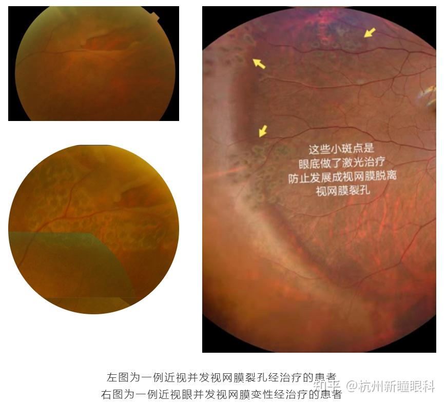 近视 眼底并发症,那是说近视眼也是一种病?