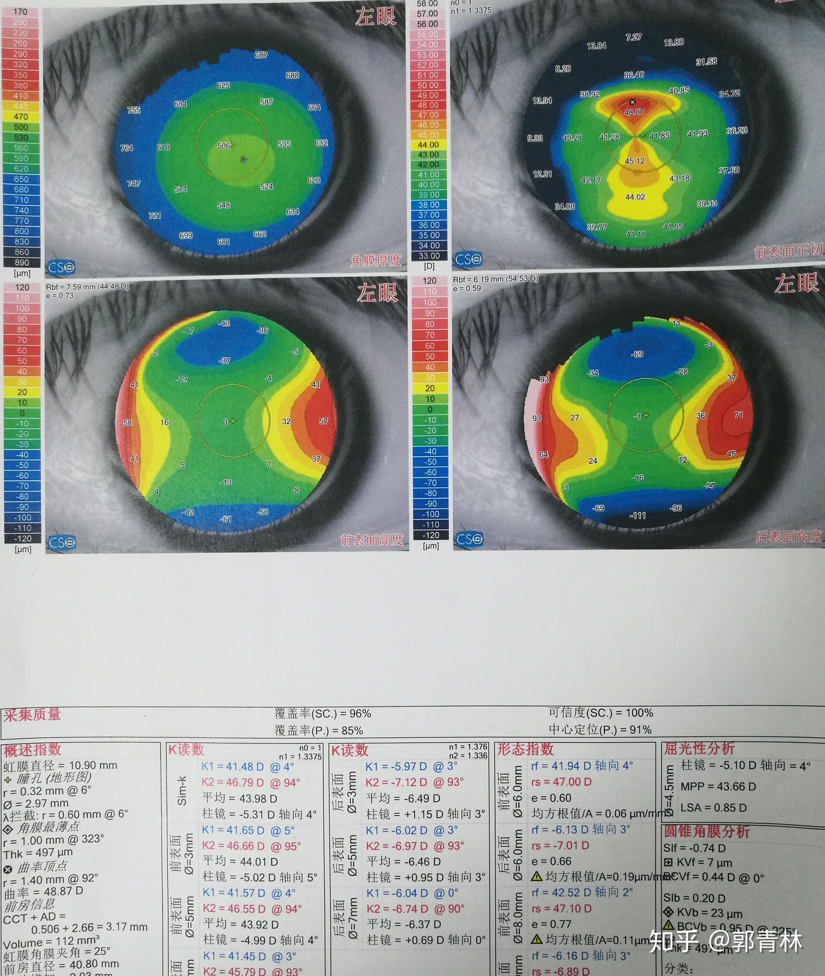 小角膜大散光的圓錐鏡片應用案例