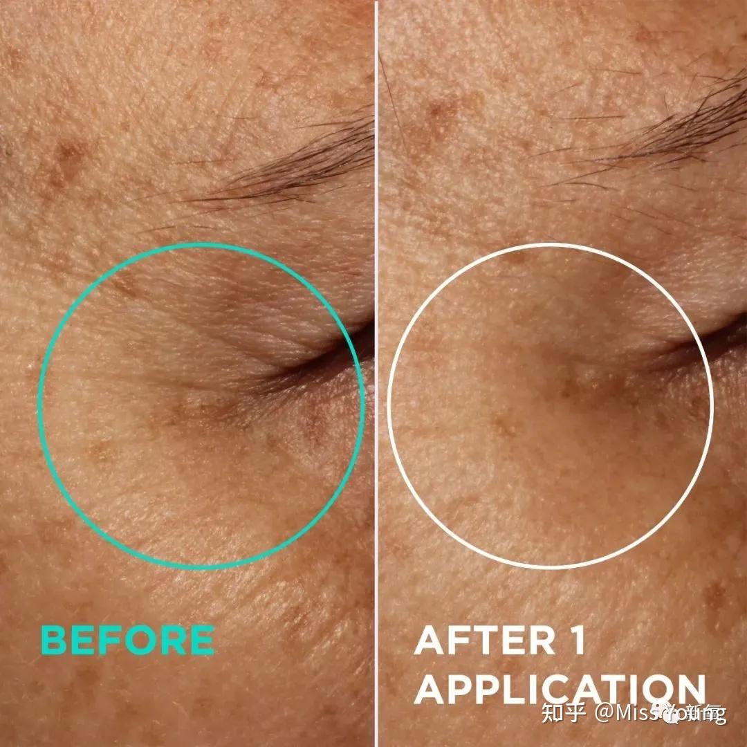 适合需要抗衰,特别是有皱纹,包括鱼尾纹,川字纹,抬头纹严重的宝宝们