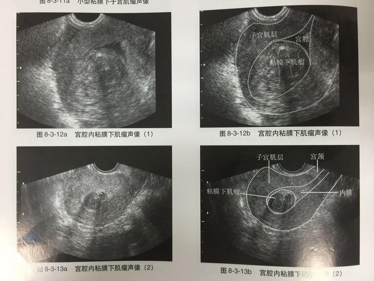 超聲：子宮肌瘤_子宮肌瘤b超顯示圖片 - 神拓網