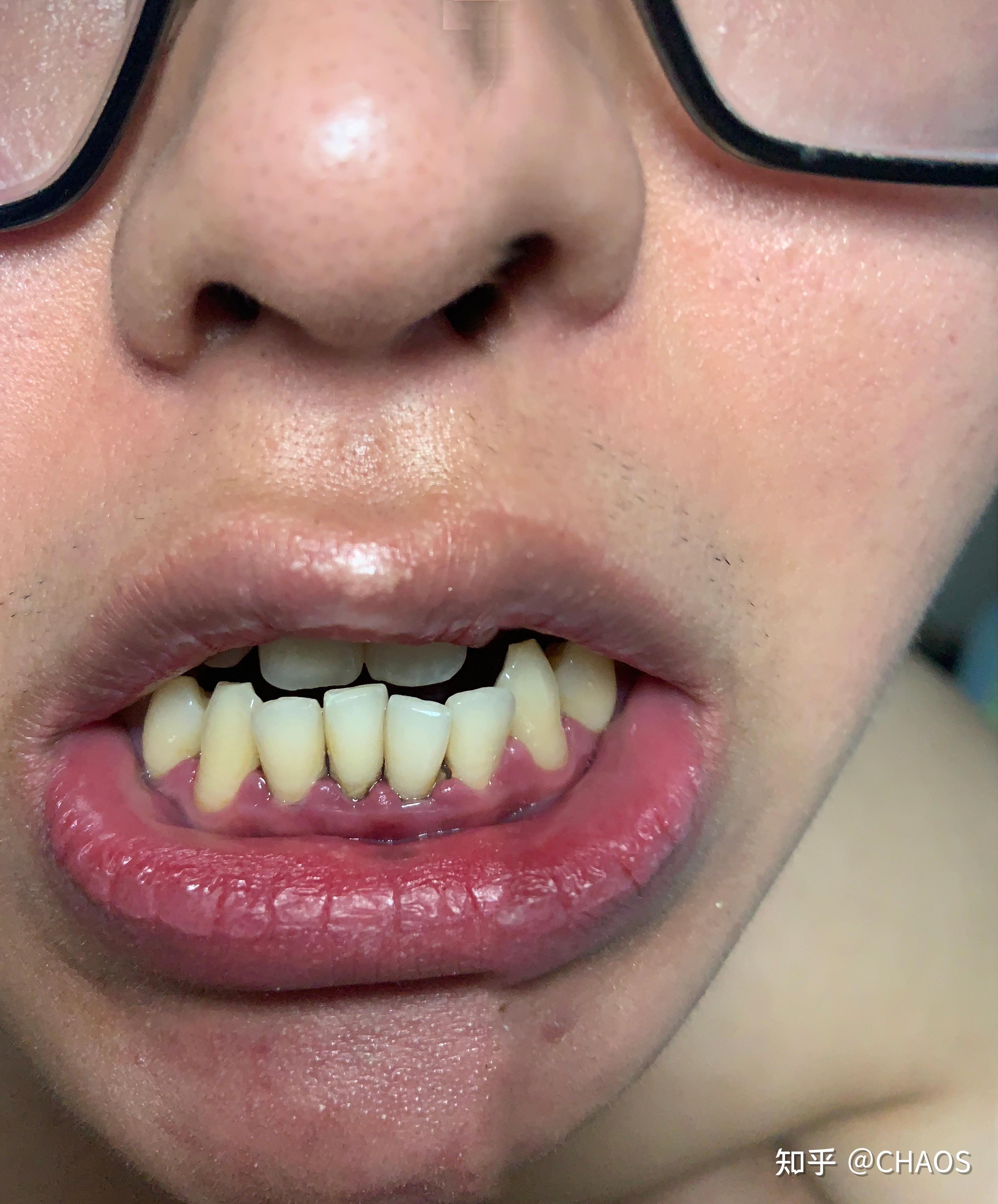 21岁牙周炎患者需要怎样的治疗？ - 知乎