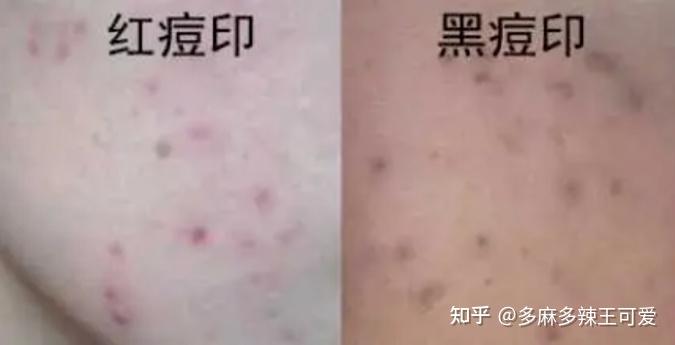 痘印是怎么形成的？ - 知乎