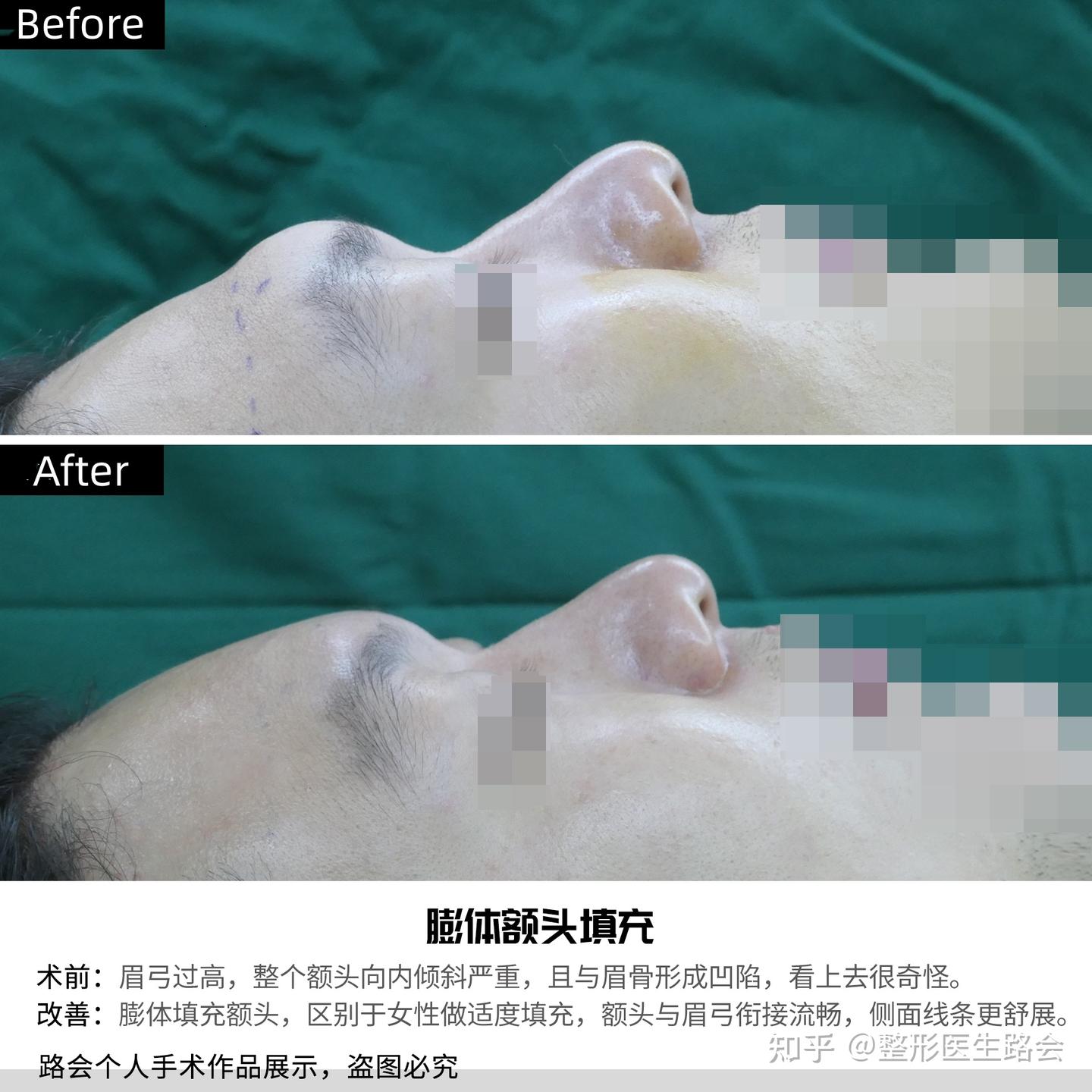 脸上这4处凹陷,拿膨体可以一次性填平,真的能变年轻! - 知乎