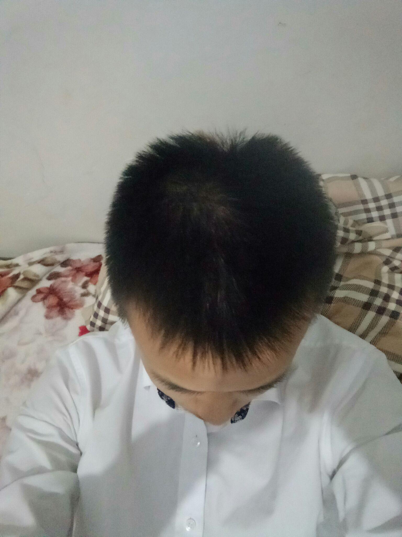 发根有白 黄 颗粒 头发油 细 疏? - 脱发