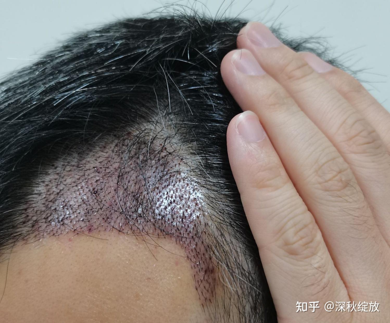 1400单位毛囊植发记录额角区域