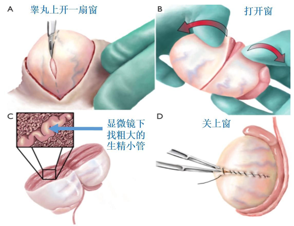 医学科普揭开显微取精的神秘面纱