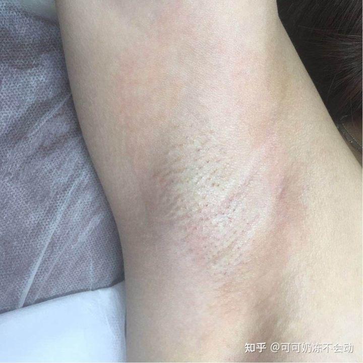女生怎么脱腋毛比较干净? - 知乎