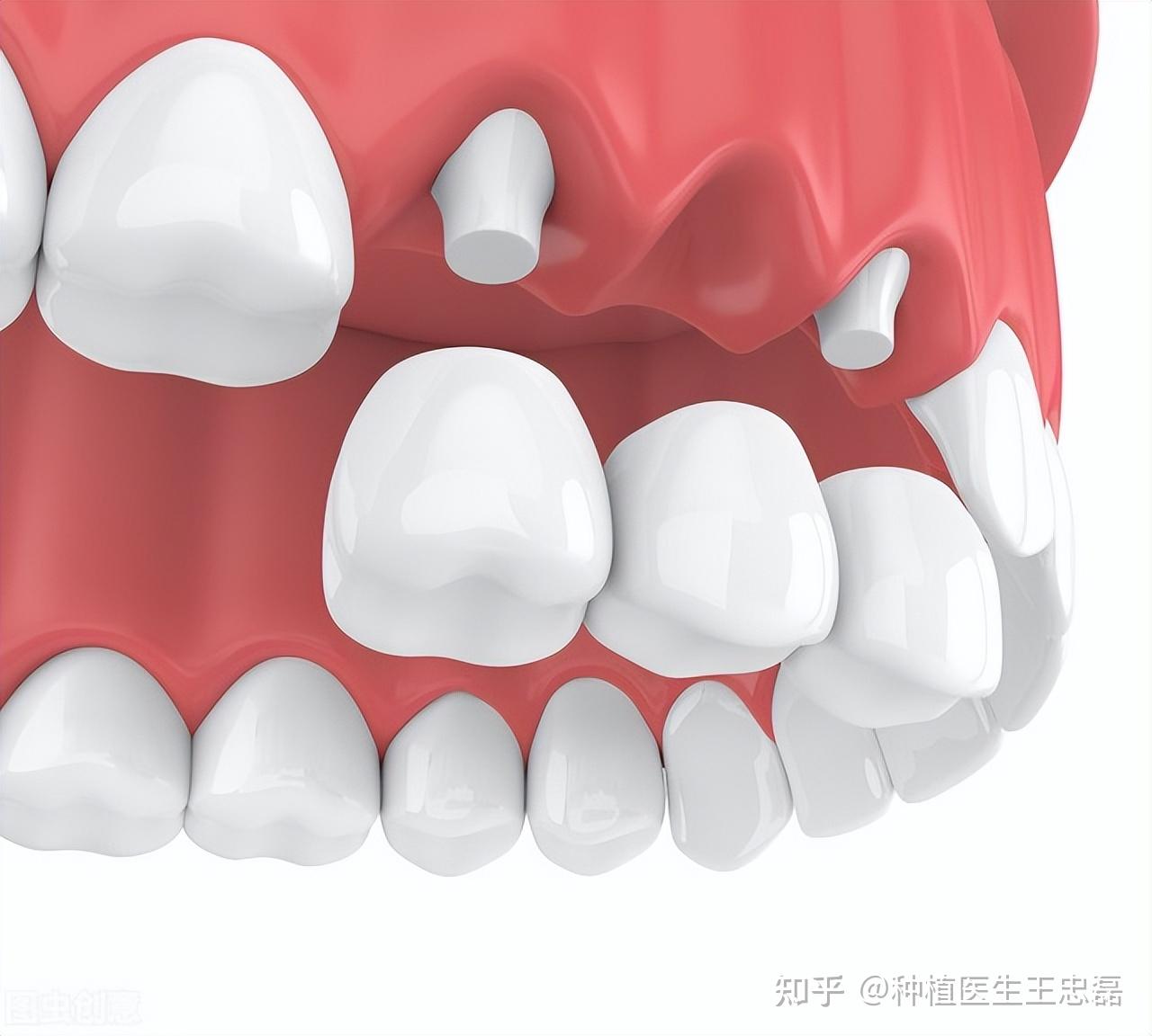 征文：种植牙桥精密研磨修复下半口-王林虎博士的博客-KQ88口腔博客