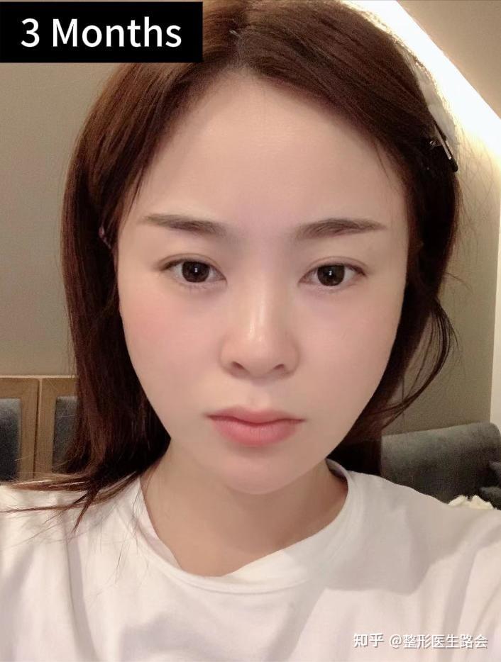 36岁“短方脸”女士奔赴北京,做全脸整形后,重新开启自信人生 - 知乎