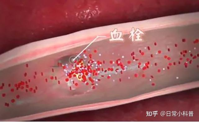 肿瘤患者的隐形杀手:静脉血栓栓塞,该如何预防呢? - 知乎