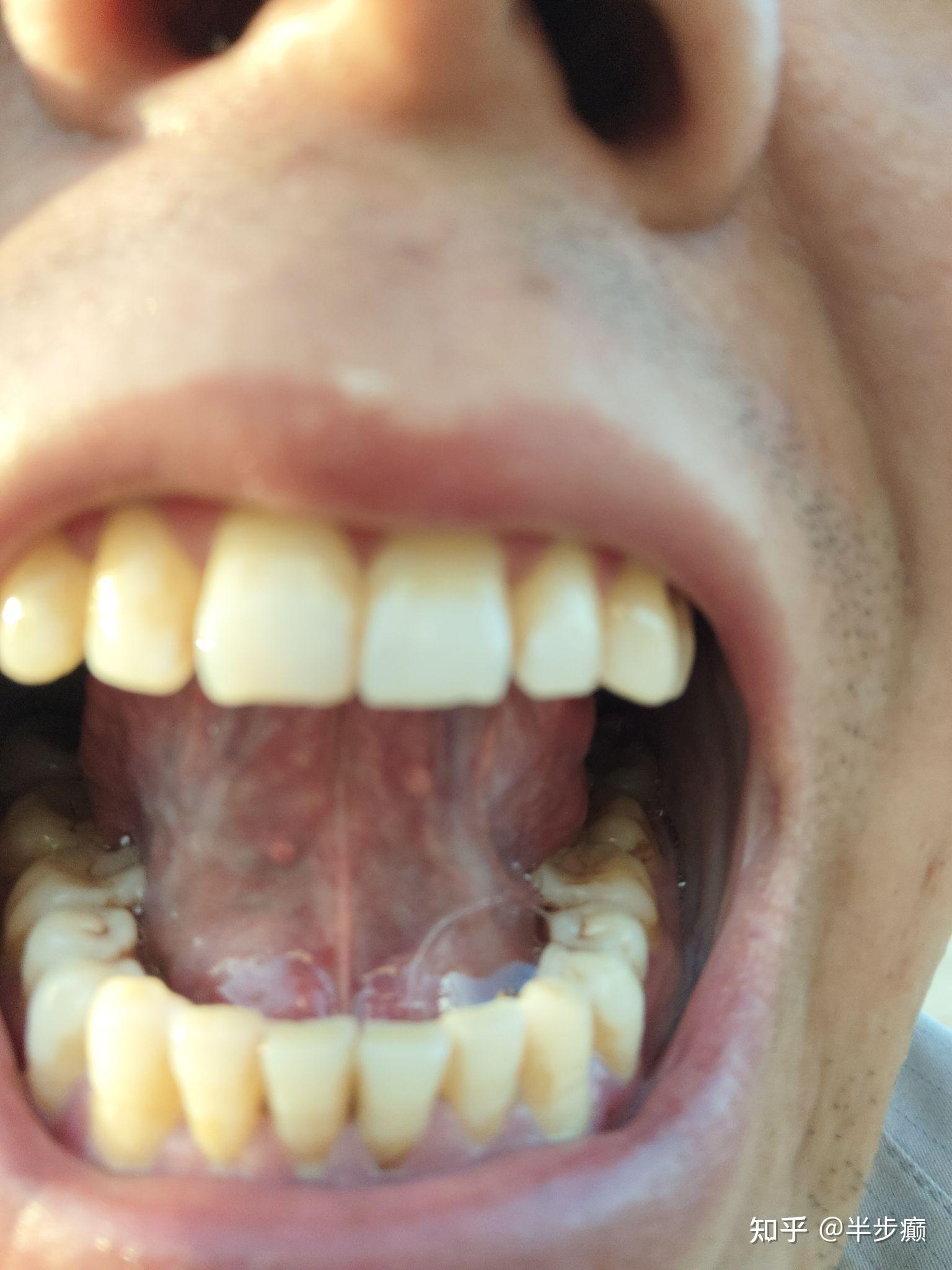 口腔舌系带疣体图片图片