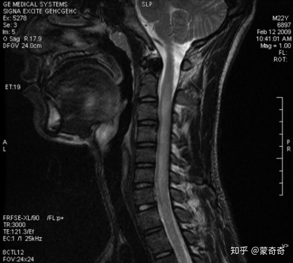 神经病变有哪些症状能不能治好 v2-0f815cebdebb95aa684b5855fbfd2789_r.jpg