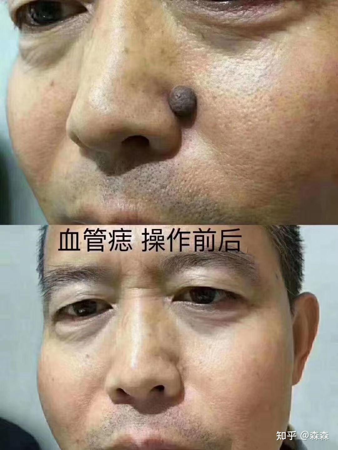 有哪些点痣前后的图? - 知乎