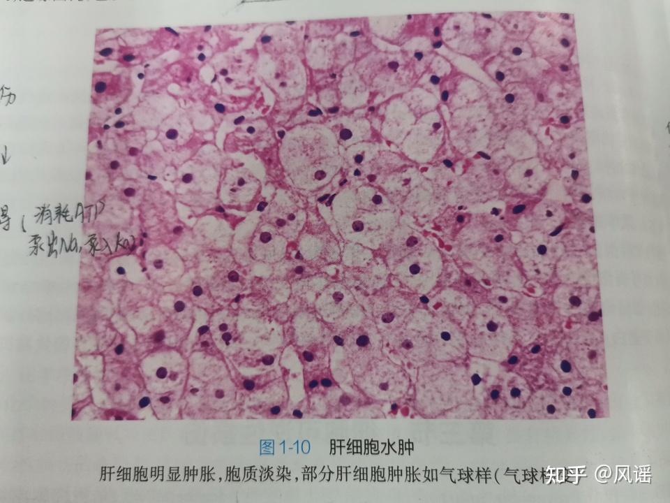 肝脂肪变性:胞浆有脂滴空泡,大小不等,核被挤到一侧3