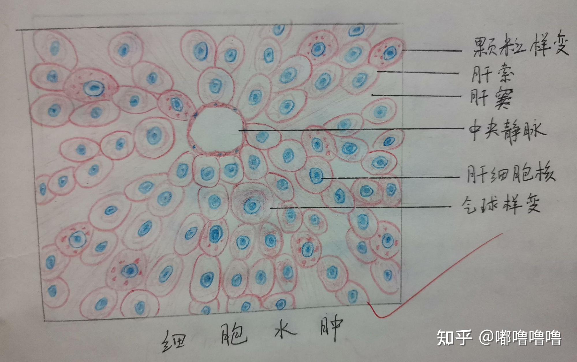 肝细胞水肿红蓝铅笔图图片