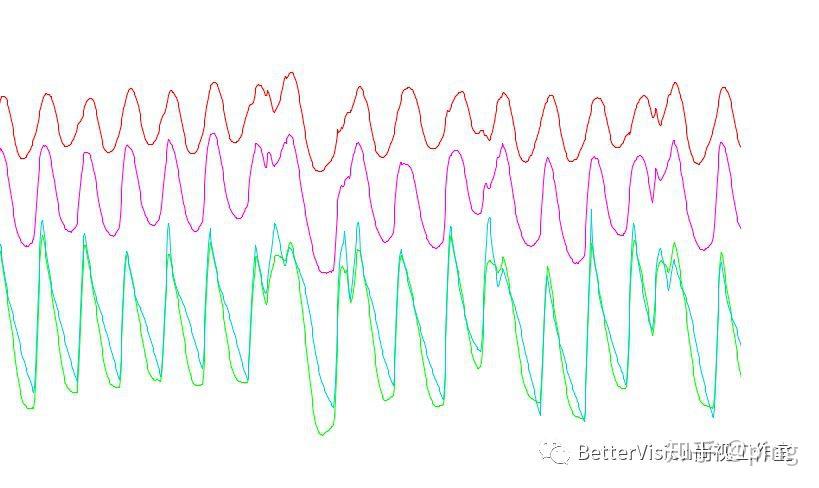 的方法是通过眼动仪来进行眼运动波形记录,通过分析各种眼球运动轨迹