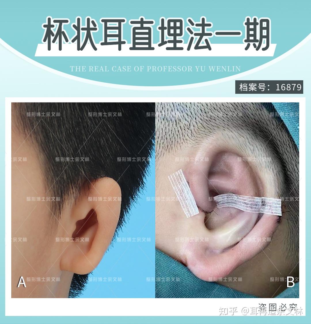 【案例分析】35岁男性患者做耳再造手术矫正小耳畸形 - 哔哩哔哩