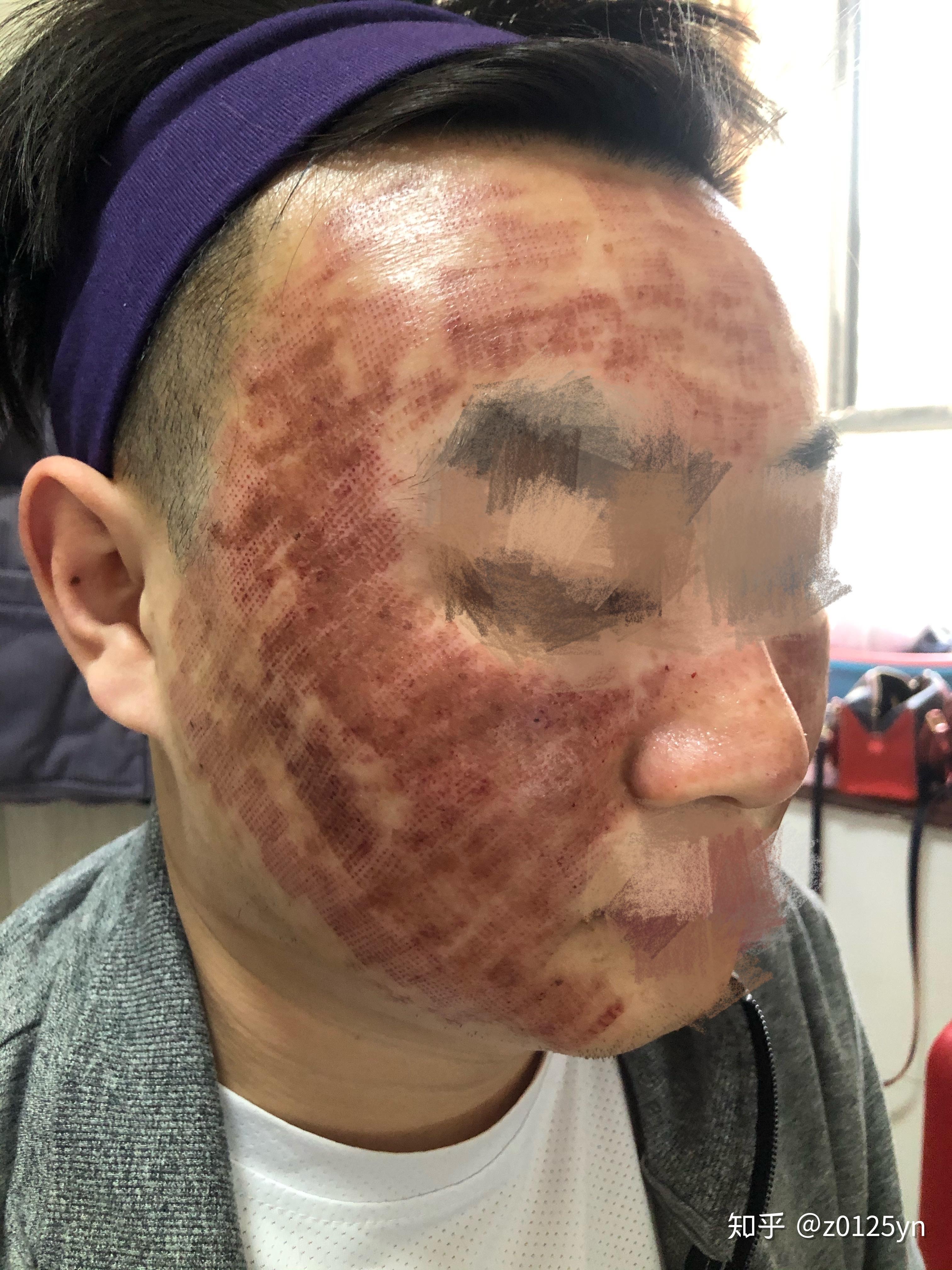 记录男朋友点阵激光的历程