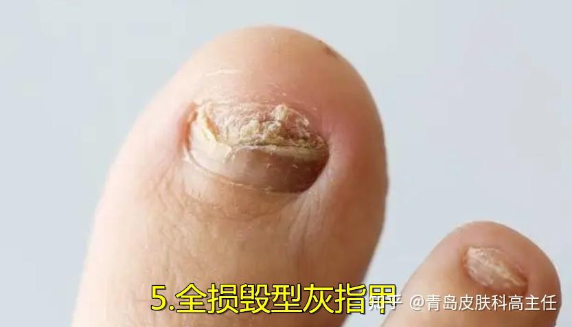 灰指甲有哪5种类型? - 知乎