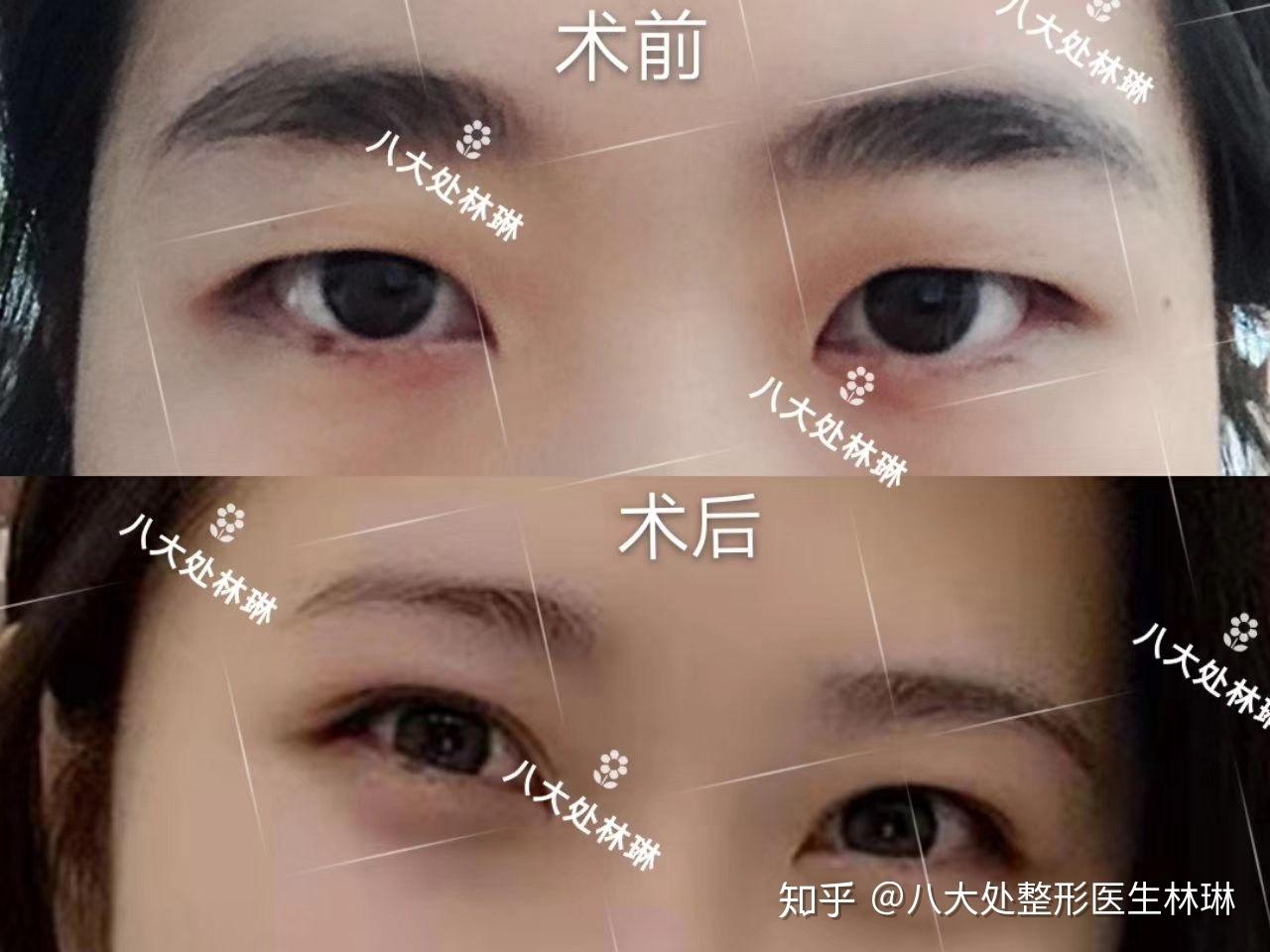 双眼皮手术解决三角眼问题