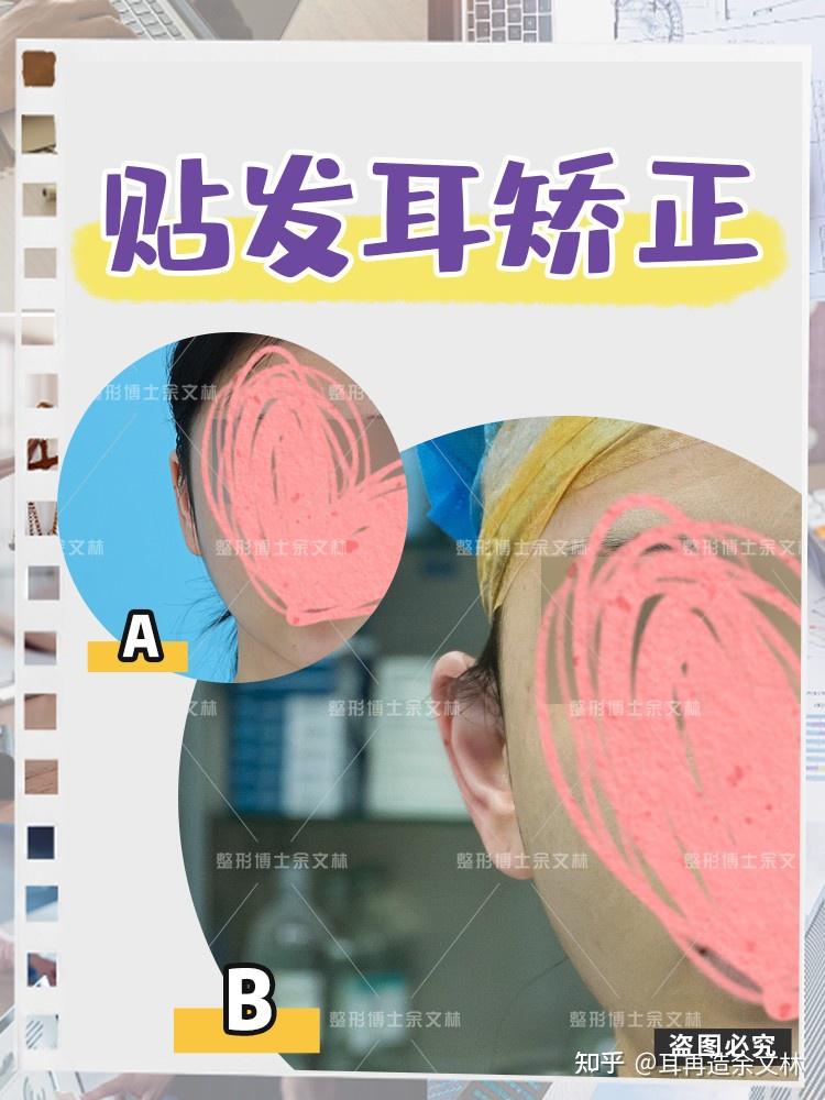 案例分析不太贴面的贴发耳可以矫正吗看看案例就知道了