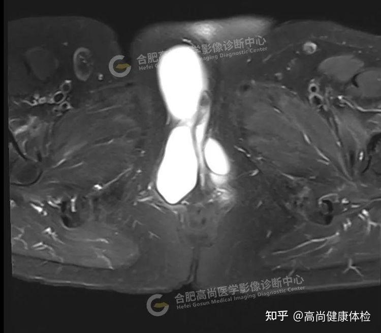 前庭大腺肿瘤图片图片