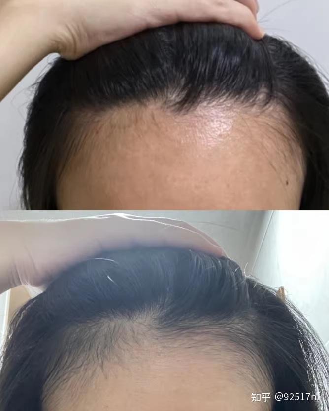 秃头真的很显老 - 知乎