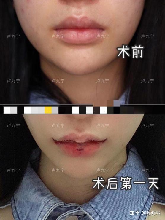 (1)创伤小,恢复快,不影响正常生活(2)手术切口隐蔽在口内,疤痕隐蔽不
