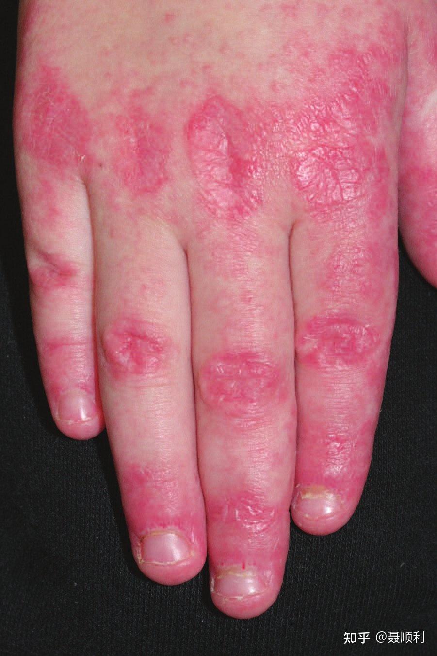 皮肌炎典型的皮疹图片图片