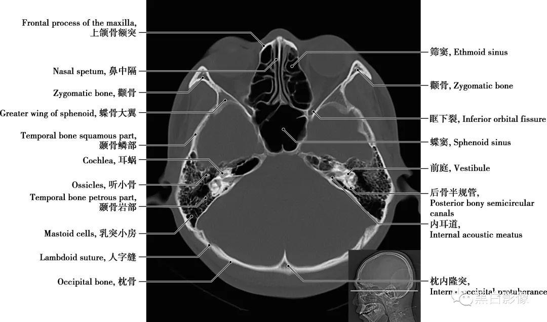 颅骨解剖图ct图片