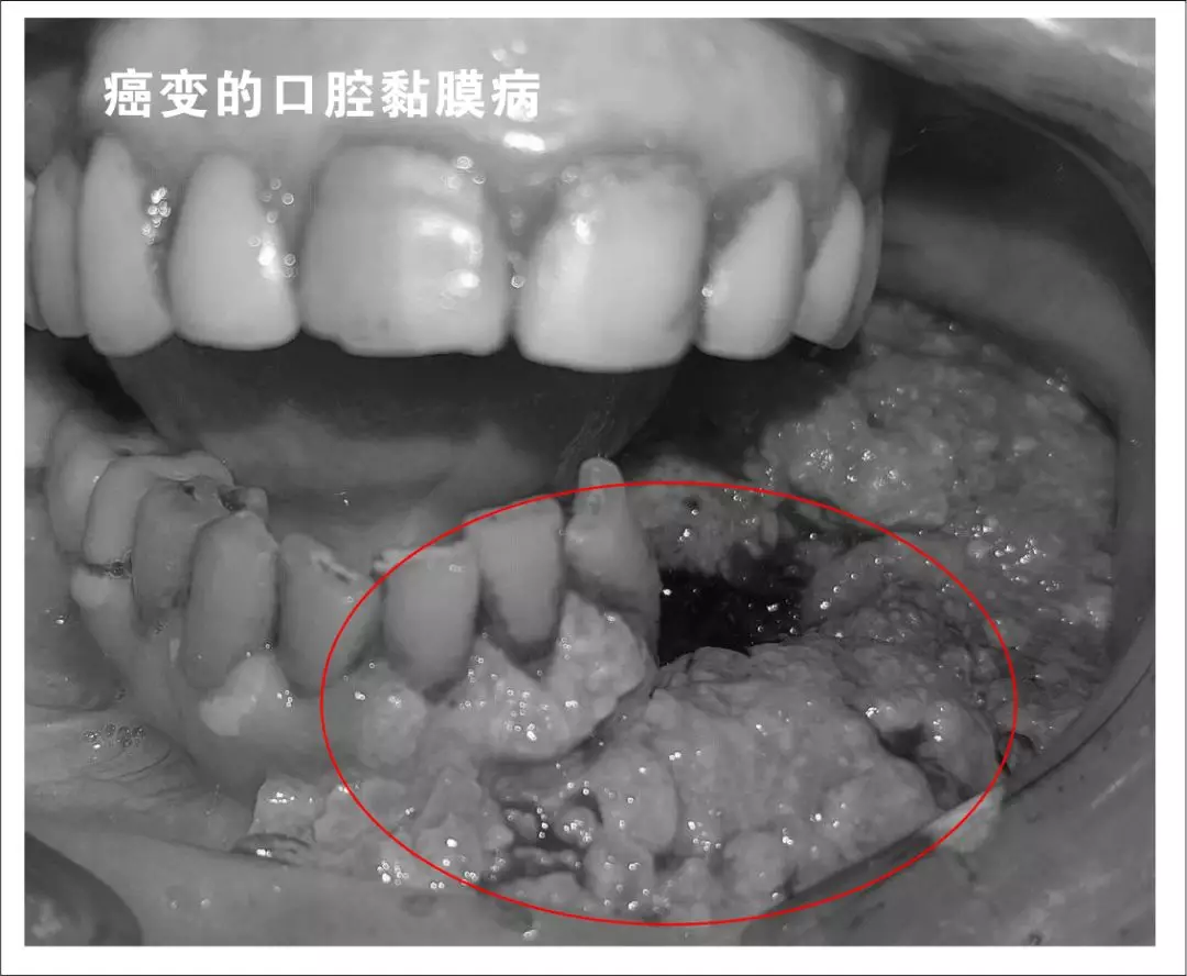 槟榔与数以万计口腔疾病患者间的博弈! - 知乎