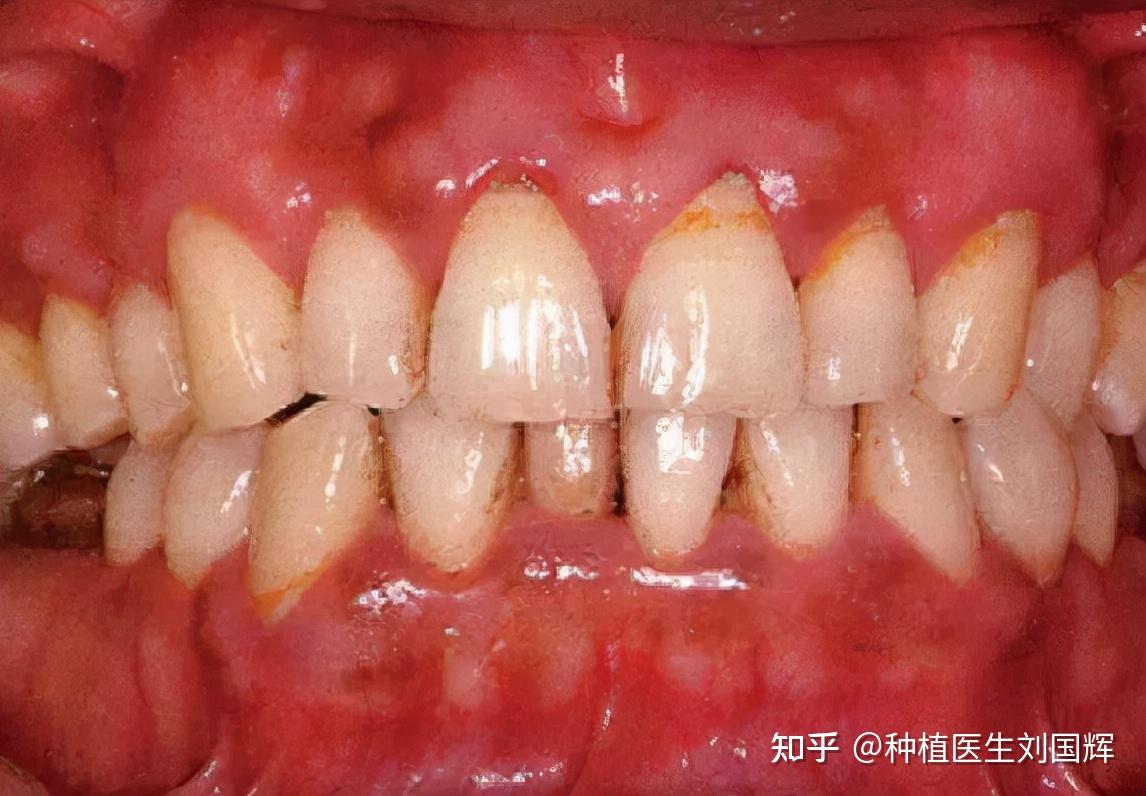 牙齿拥挤、牙槽骨太薄、慢性牙周炎，19个月完成矫正 - 知乎