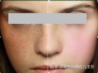 脸上长斑 是中医调理还是激光治疗 知乎 脸上长斑 是中医调理还是激光治疗 知乎