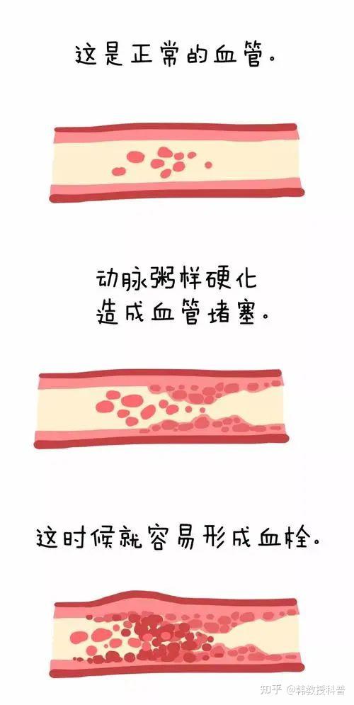 血管“硬化”怎么办? - 知乎