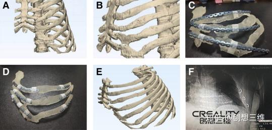 3d打印机改善肋骨骨折手术的可行性研究 知乎