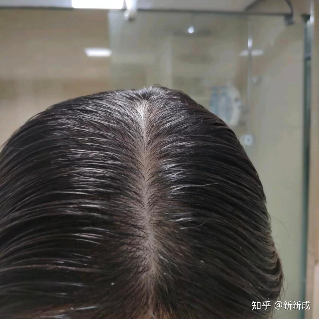 男生经常掉头发,感觉自己发际线后移,有什么推荐的防脱洗发水吗?
