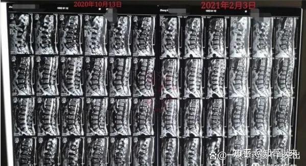 棘间韧带水肿 zhuanlan.zhihu.com