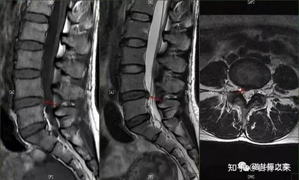 腰椎间盘突出ct片子怎么看？教你看腰椎间盘突出ct影像学表现 知乎