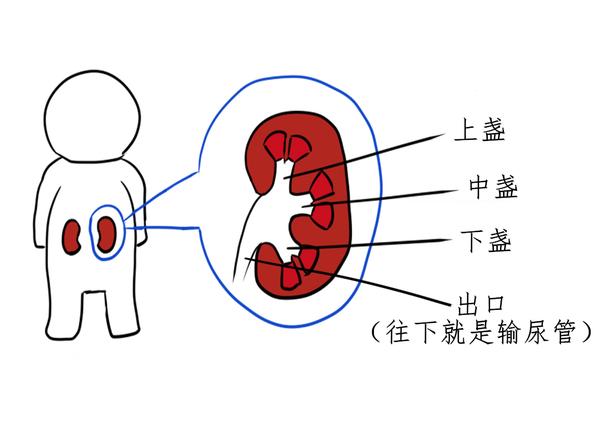 肾结石排石图解图片