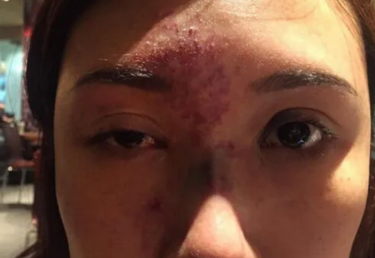 热玛吉有什么风险做热玛吉该如何避坑一篇文章让你告别小白