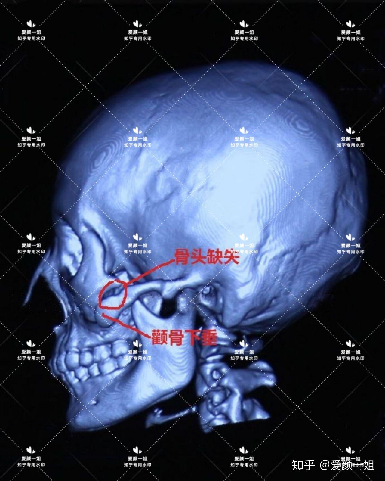 颧骨ct解剖图谱图片
