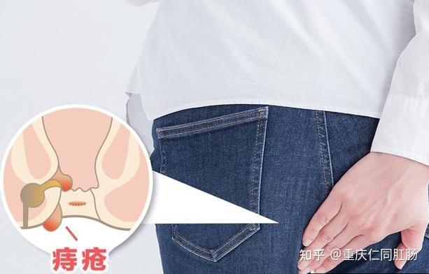 重庆治肛门医院怎样区分痔疮还是肠癌痔疮会发展成癌吗