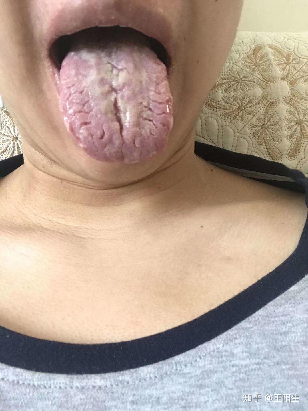 舌苔裂纹病症图片