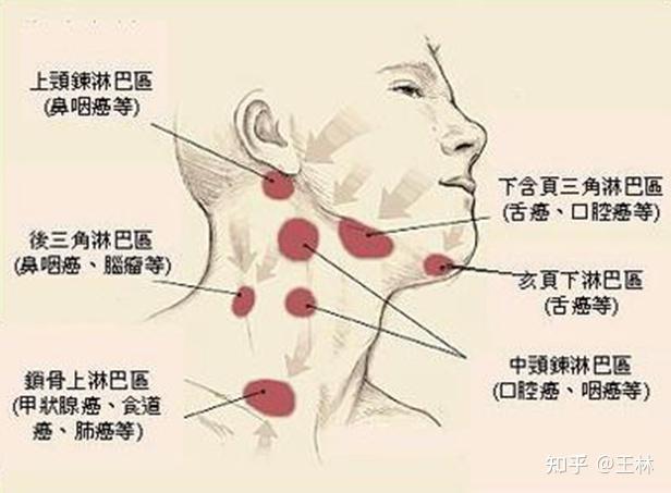 喉结淋巴图片