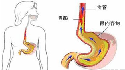 反流性食管炎的胸痛通常被描述为压榨痛或烧灼痛