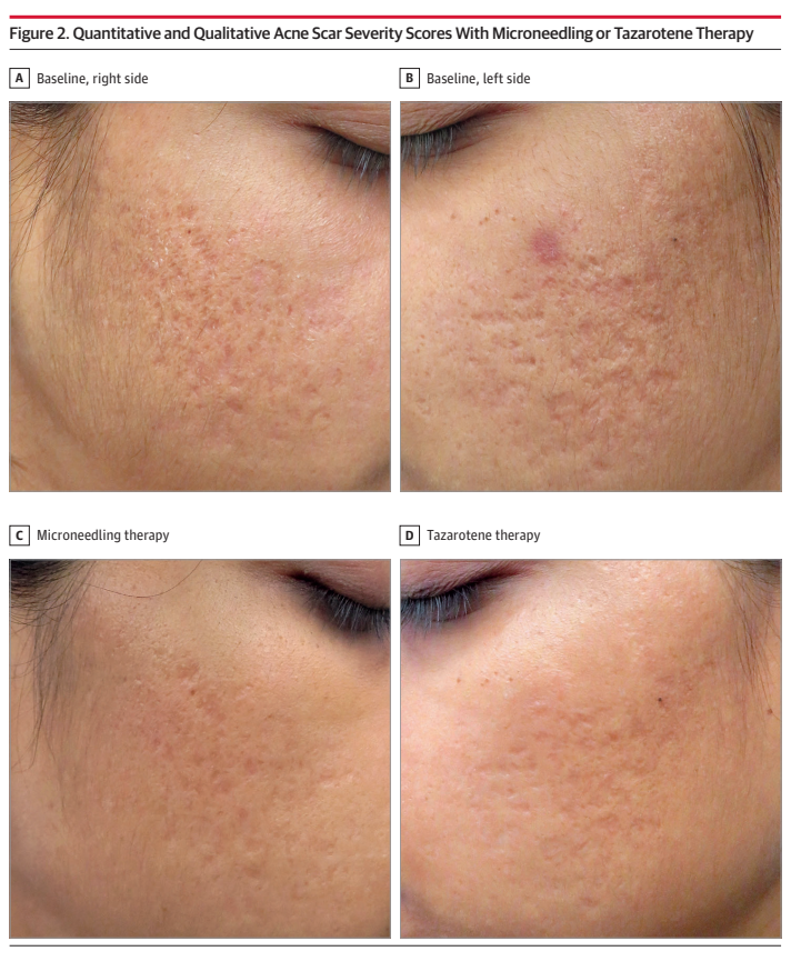 20元就能改善痘坑——他扎罗汀是什么神仙?