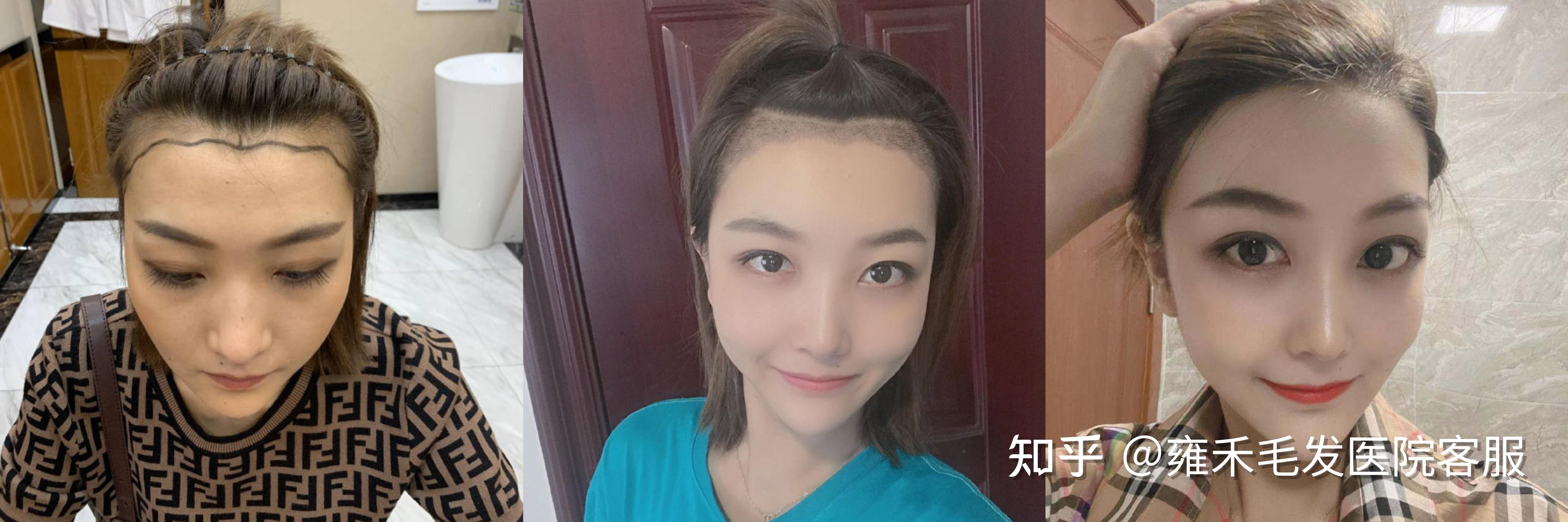 女性天生发际线高,前额头发稀少,可以做植发改善吗?