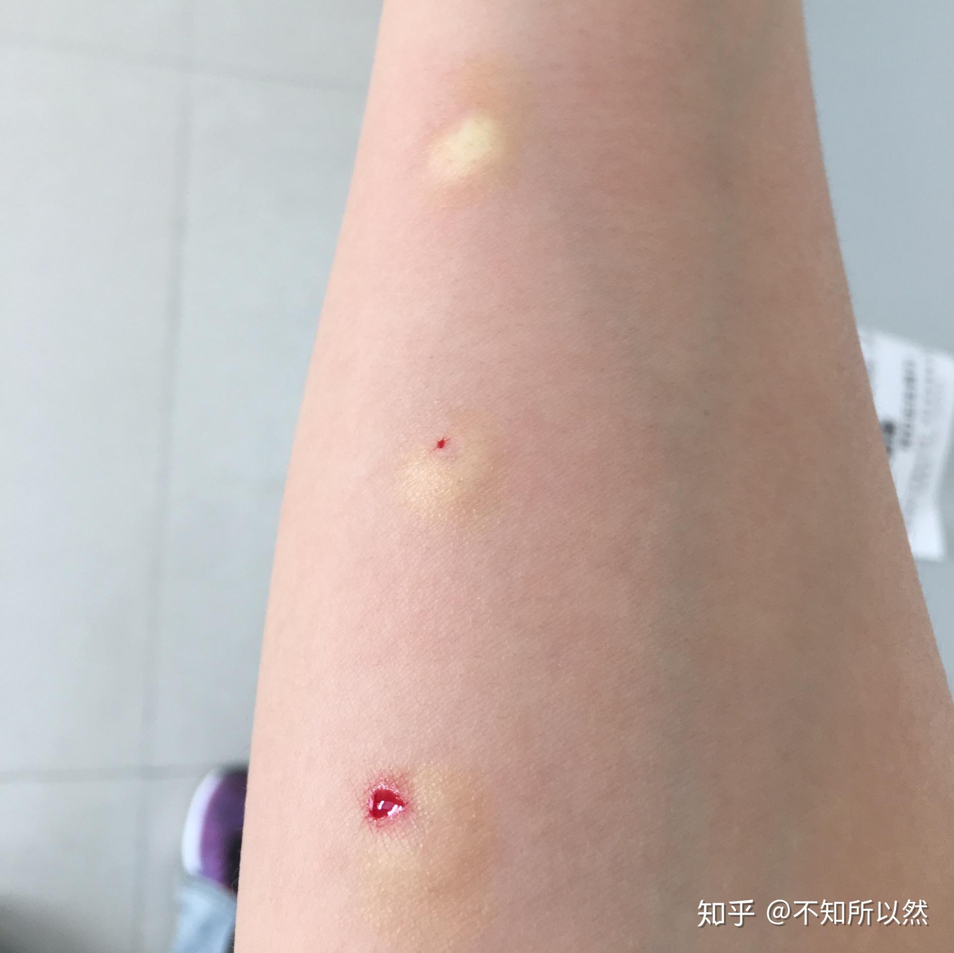 疑似肺结核的第一天