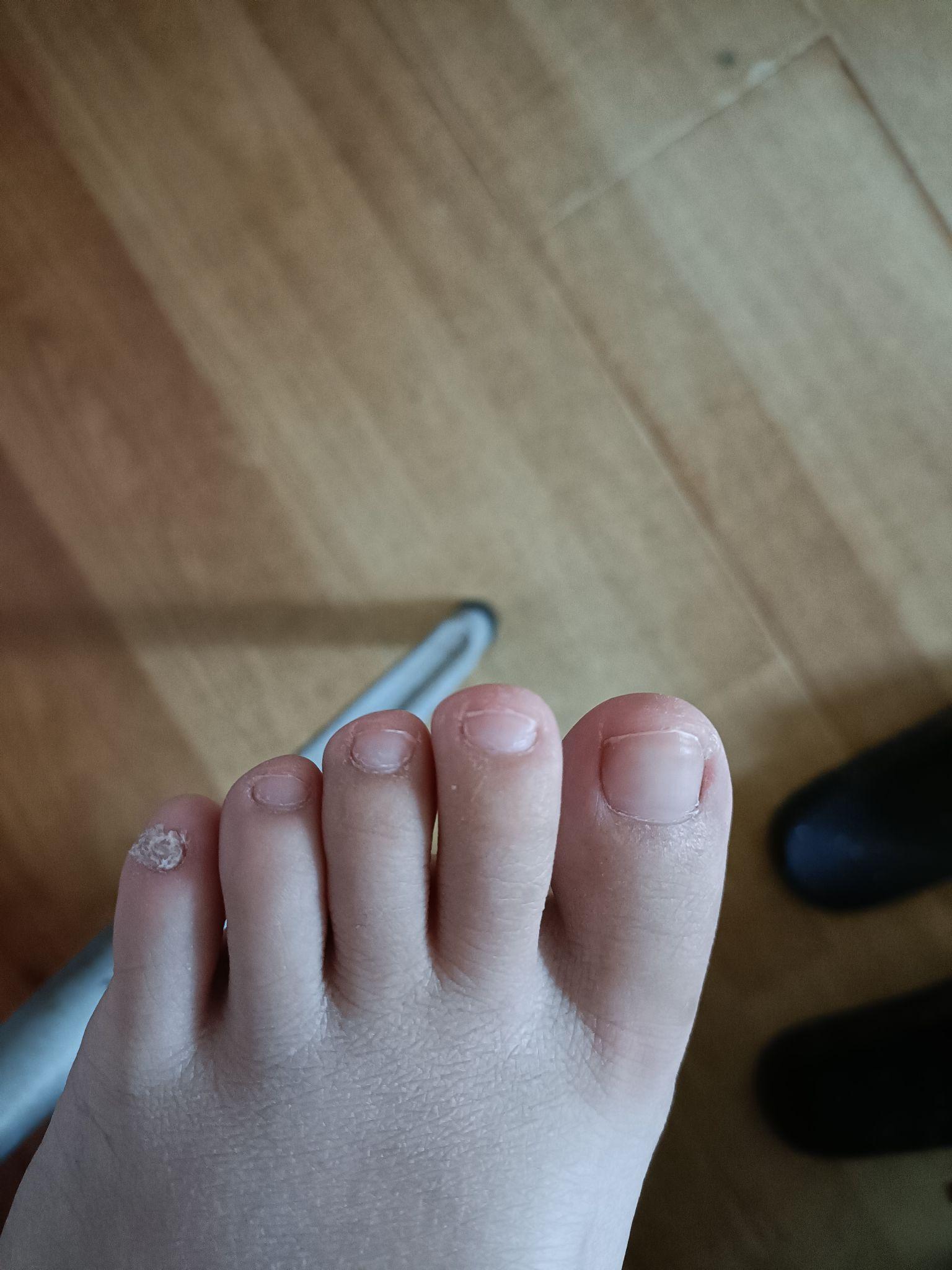 小脚趾的指甲特别难看怎么办